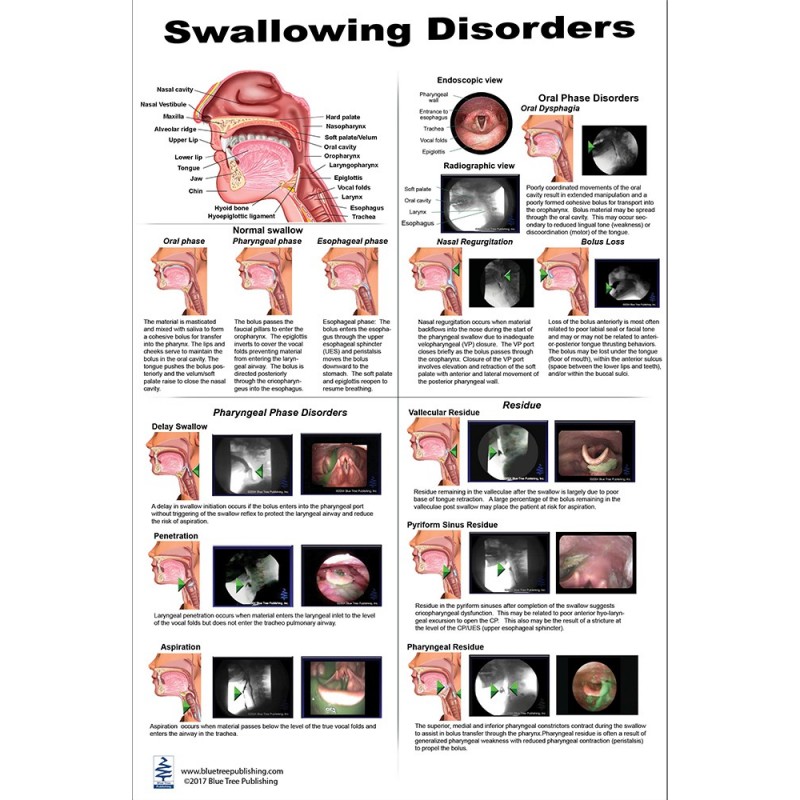 Swallowing Disorders Regular Poster