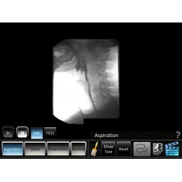 Swallowing Aspiration Disorders Mobile App MBS video view