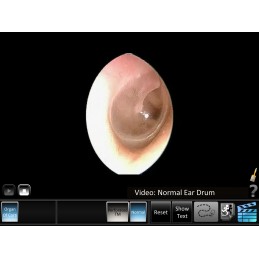Ear Disorder - Inner Ear Mobile App normal ear drum video