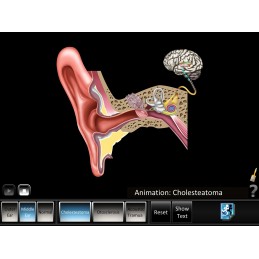 Ear Disorders - Outer Middle Ear Mobile App cholesteatoma animation