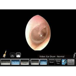Middle Ear ID Mobile App normal eardrum video