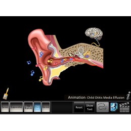 Ear Disorders - Otitis Media Mobile App child OME