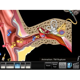 Ear Disorders - Otitis Media Mobile App suppurative animation