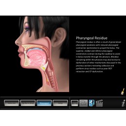 Swallowing Residue Disorders Mobile App pharyngeal residue animation