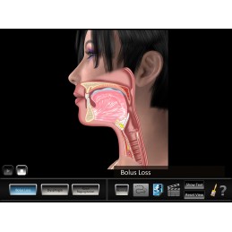 Swallowing Oral Disorders Mobile App bolus loss animation