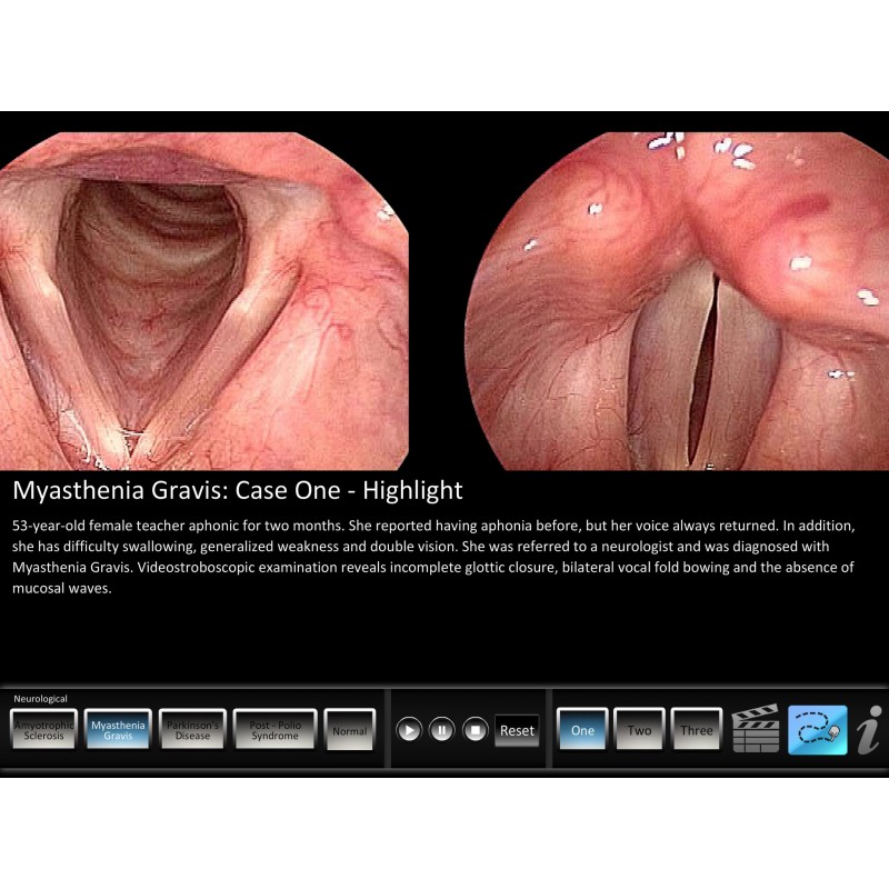 Vocal Pathology - Neurological Mobile App