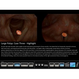 Vocal Pathology - Polyps Mobile App zoomed in highlight