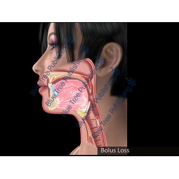 Swallowing Bolus Loss Animation - Download Video