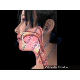 Swallowing Vallecular Residue Animation - Download Video