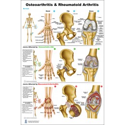 Osteoarthritis and Rheumatoid Arthritis Regular Poster