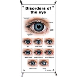 Eye Disorders Small Poster with stand
