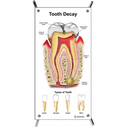 Tooth Decay Small Poster with stand
