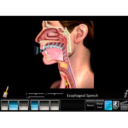 Laryngectomy Computer App Esophageal Speech