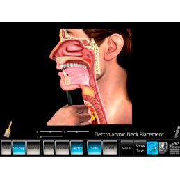 Laryngectomy Computer App Electrolarynx Neck Placement