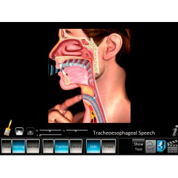 Laryngectomy Computer App Tracheoesophageal Speech Animation