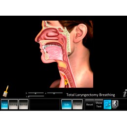 Laryngectomy Computer App Total Laryngectomy Breathing
