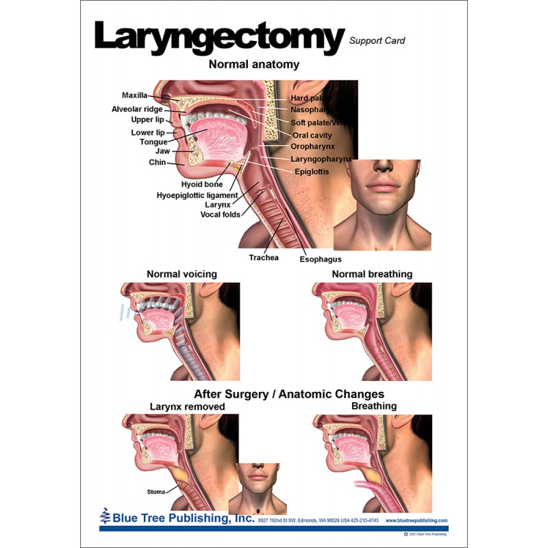Laryngectomy Anatomical Chart front