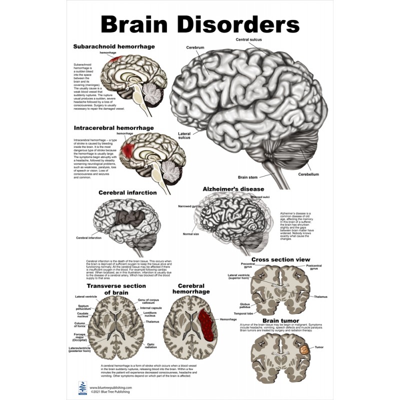 Brain Disorders Large Poster