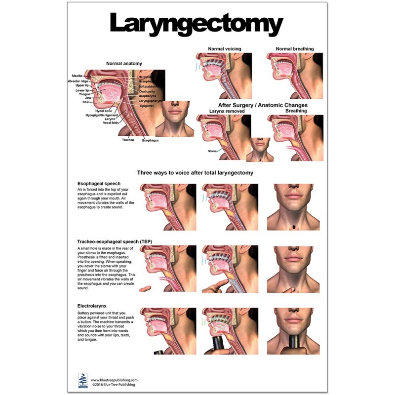 Laryngectomy Regular Poster